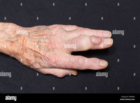 Ganglion Cyst Finger