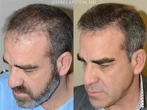 Hair Transplants For Men Photos Miami FL Patient54176