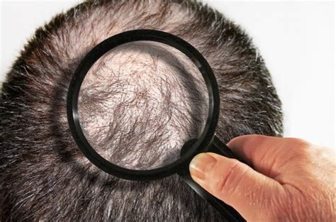 most common types of hair loss docgenie blog