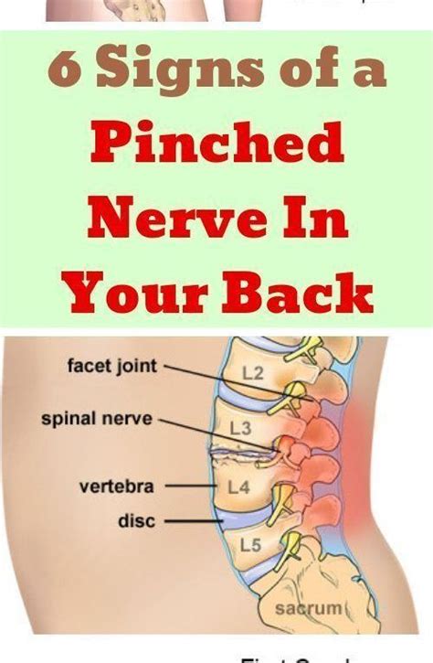 Here Are 6 Signs Of A Pinched Nerve In Your Back Pinched Nerve