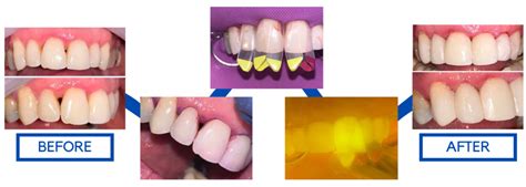Black Triangle Treatment Waiheke Dental