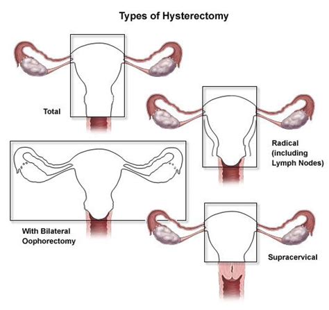 Types Of Hysterectomy Hysterectomy Partial Hysterectomy Uterine Prolapse