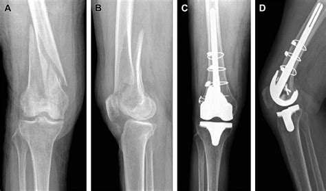 Management Of Distal Femur Fractures In Adults Orthopedic Clinics