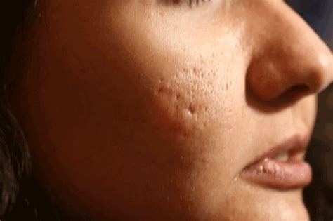 How To Improve Pitted Scars Wrytin