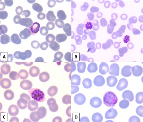 Plasmodium Vivax In Giemsa Stained Thin Blood Smear Wit Open I