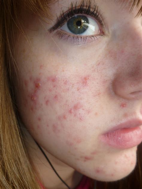 Life On Roaccutane Introduction And My Acne Story So Far Lets Kiss