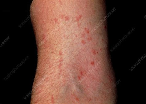 Scabies Infection On The Arm Stock Image M2600117 Science Photo