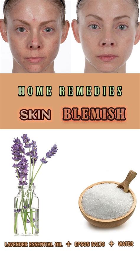 32202home Remedies Skin Blemish Natural Skin Care Natural Skin