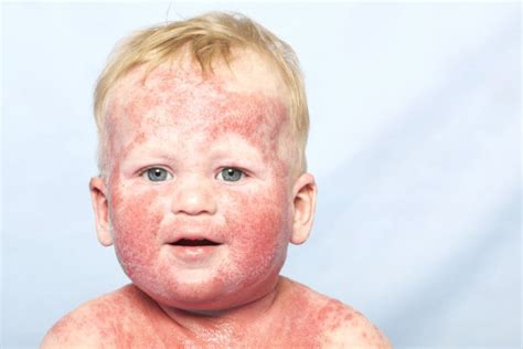 Dermatite Atopica Nei Bambini Foto Per Riconoscerla Nostrofiglio It