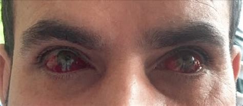 Bilateral Subconjunctival Hemorrhage Secondary To Use Of Abciximab