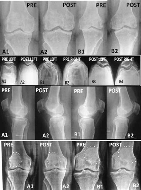 Row 1 The Femur And Tibia In The Medial Compartment Of Both Knees