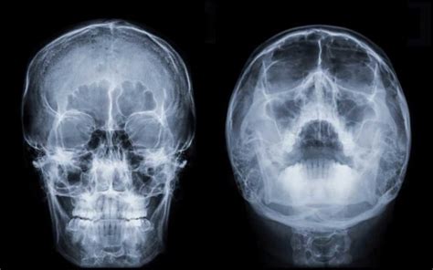 Radiografias Dos Seios Da Face Tomos 3d