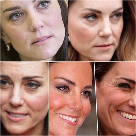 Kate Middleton Nose Job Before And After