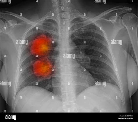 Metastatic Melanoma Of The Lungs Stock Photo Alamy