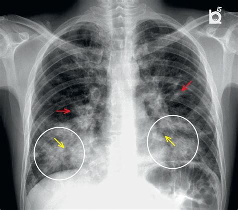 45 Year Old Male Patient With Hiv Chest X Ray Interpretation
