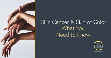 Skin Cancer In People Of Color The Skin Cancer Foundation