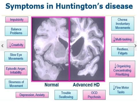 Stages Of Huntingtonsstages Of Huntingtons Diseasedisease There Are Five Stage Of Hd 1 Precli