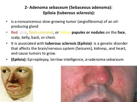 Dermatology Disorders Of Sebaceous And Sweat Glandsdrfaraydwn