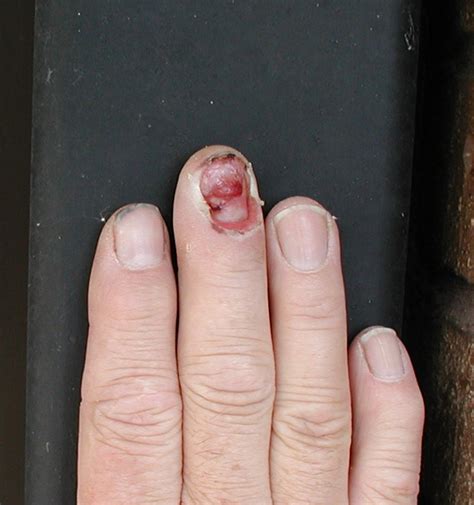 All 95 Images What Does A Dying Fingernail Look Like Superb 10 2023