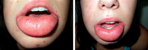 How To Deal With Swollen Lips
