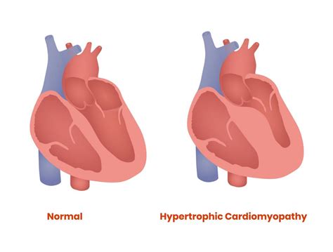 Hypertrophic Cardiomyopathy Treatment Nyc Division Of Cardiology