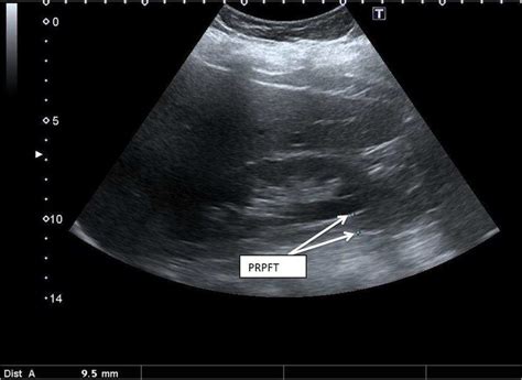 Abdominal Ultrasound Of 58 Years Old Female Patient Showing A The