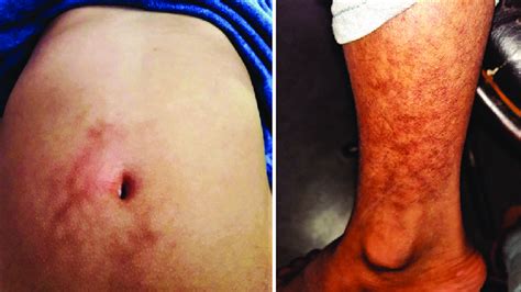 Unilateral Livedo Reticularis With A Broken Fishnet Pattern Involving