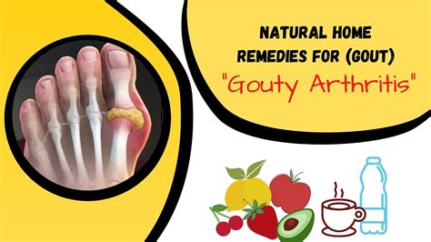 14 Natural Home Remedies For Gout Gouty Arthritis Pain Relief Youtube