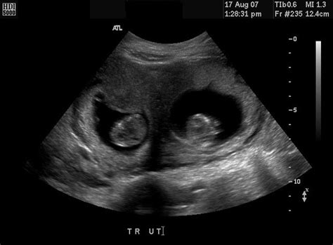 2 Month Pregnancy Ultrasound Pictures Garangan Mambudem