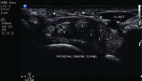 Ultrasound Of Proximal Carpal Tunnel Arrowheads Flexor Retinaculum