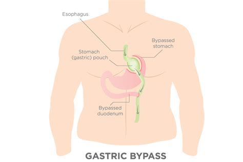 Recovering From Gastric Bypass Surgery