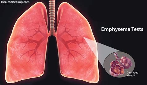 Emphysema Tests Prep Procedure Results Treatment By Dr Kaushal