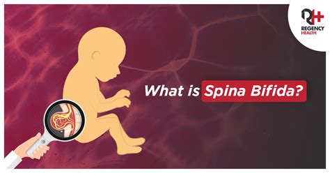 What Is Spina Bifida Blogs Regency Healthcare Ltd