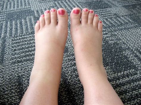 Kidney Disease Edema In Feet Kidney Failure Disease