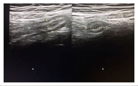 Figure1 Longitudinal A And Transverse B Real Time Us Scan Of Acute