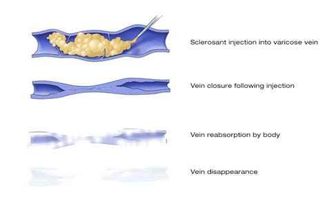 Dr Johan Blignaut Foam Sclerotherapy For Varicose Veins
