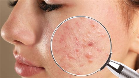 Acne Scars And Dark Spots What Are They And How Do You Get Rid Of Them