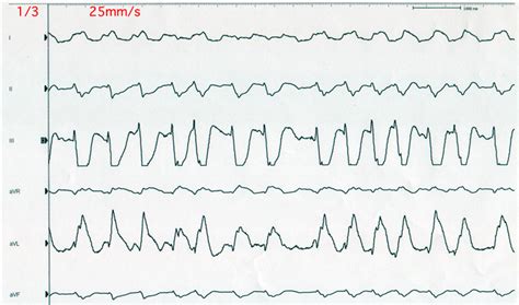 pulseless electrical activity and asystole cardiovascular medbullets step 2 3