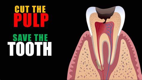 Pulpotomy In Permanent Teeth Dr Benin Youtube
