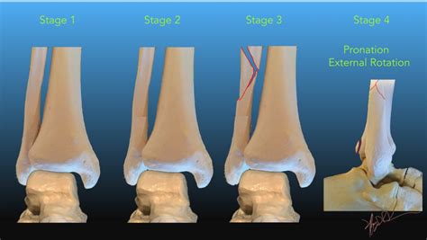 Lauge Hansen Classification Of Ankle Fractures Uw Emergency Radiology