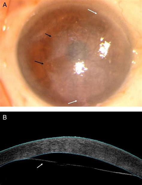 Corneal Edema After Cataract Surgery Doctorvisit