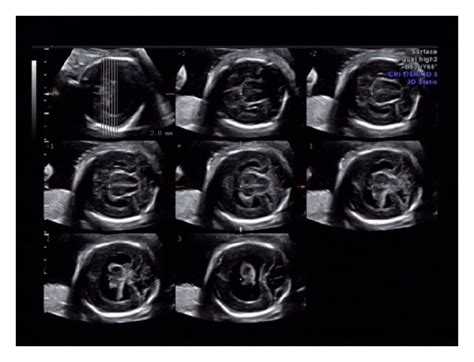 Sonographic Findings In Case 1 At 23⁺¹ Weeks A In Two Dimensional