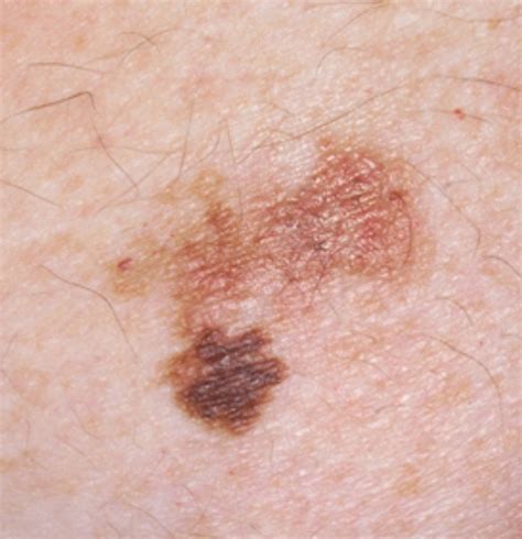 Pictures Of Skin Cancer Skin Cancer White Spots