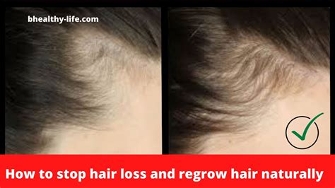 How To Stop Hair Loss And Regrow Hair Naturally Bhealthy Life
