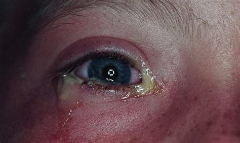 Study Medical Photos Bacterial Conjunctivitis A Brief Introduction