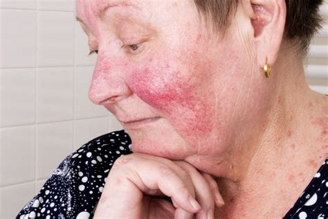 Elderly Woman With Rosacea Facial Skin Disorder Knoxville