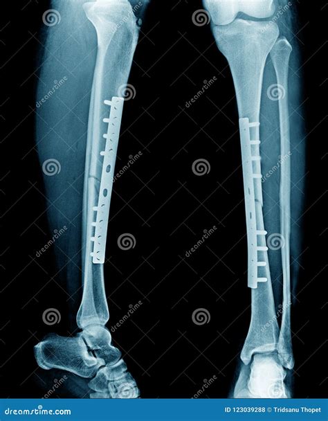 Fracture Tibia Bone With Post Op Fixation Stock Photo Cartoondealer