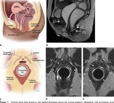 Figure 1 From Imaging And Surgical Management Of Anorectal Vaginal
