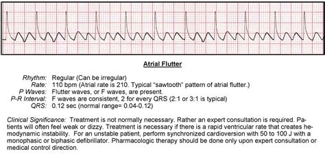 Atrial Fibrillation Vs Atrial Flutter Ecg