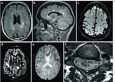 Yet, the specificity of mr is limited. | Typical imaging features of multiple sclerosis with ...